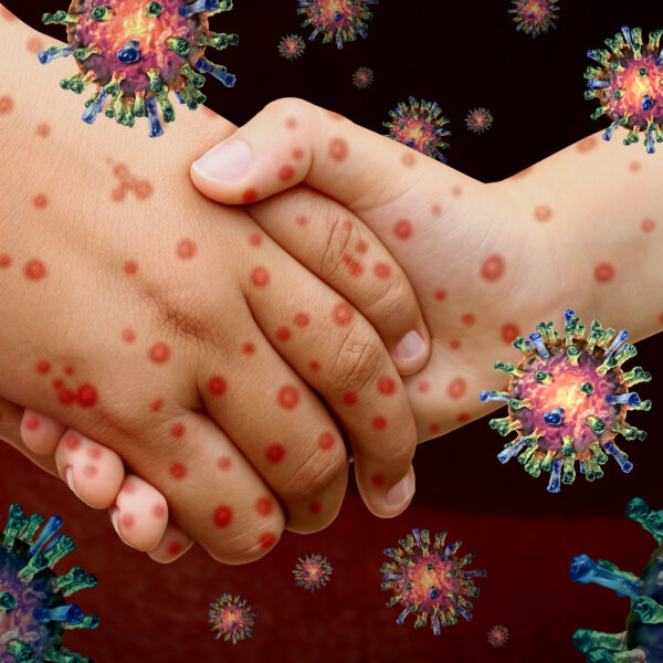 Measles 2024: What You Need to Know